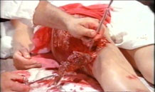 Skin exchange.